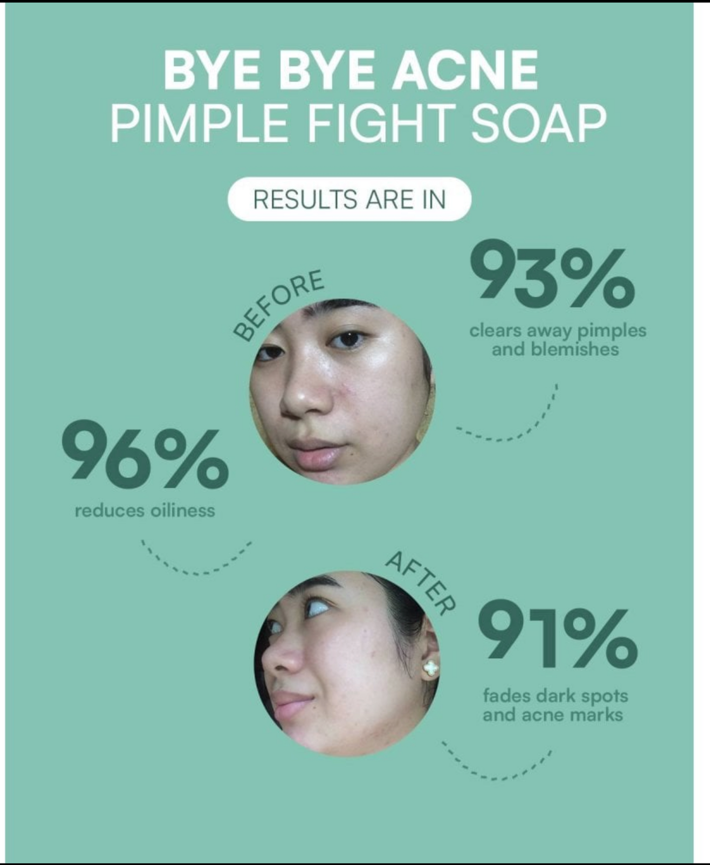 Seoul White Bye Bye Acne Whip Soap 120g - Pimple-Fighting Foam Cleanser with Free Pimple Patches